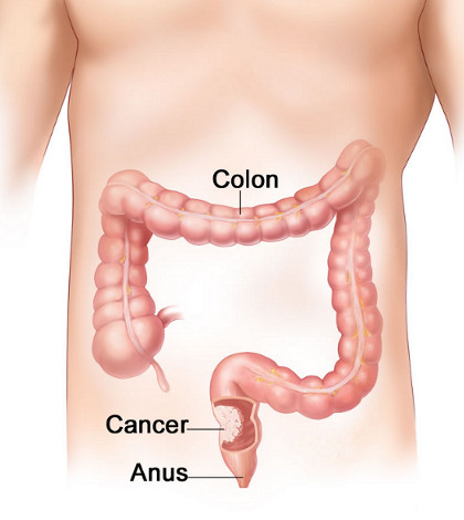 ColonCancer